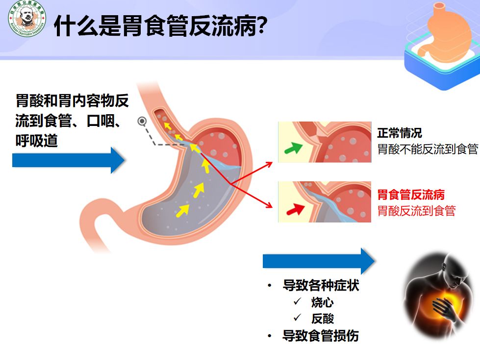 食疗缓解胃酸反流问题的方法与效果