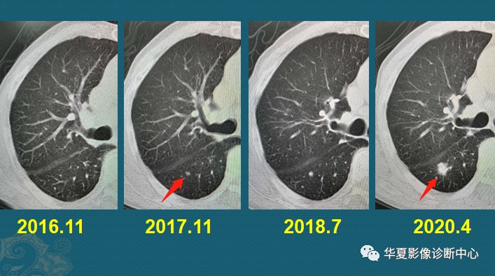 肺腺癌转移速度概览表