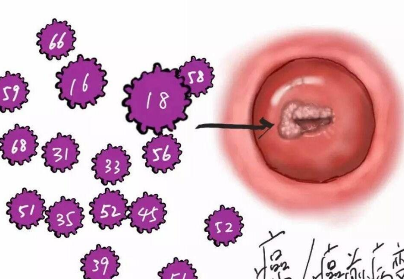 HPV病毒详解，治疗方法与应对策略