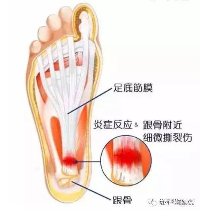 厚底雪地靴与足底筋膜炎风险探究