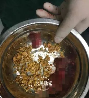 网络直播饮食文化对健康的影响，是否会诱发胆结石？